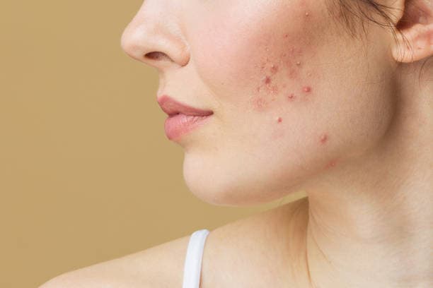 concern-acne-1.jpg