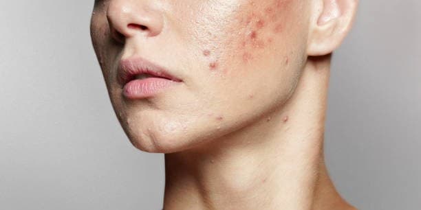 concern-acne-2.jpg