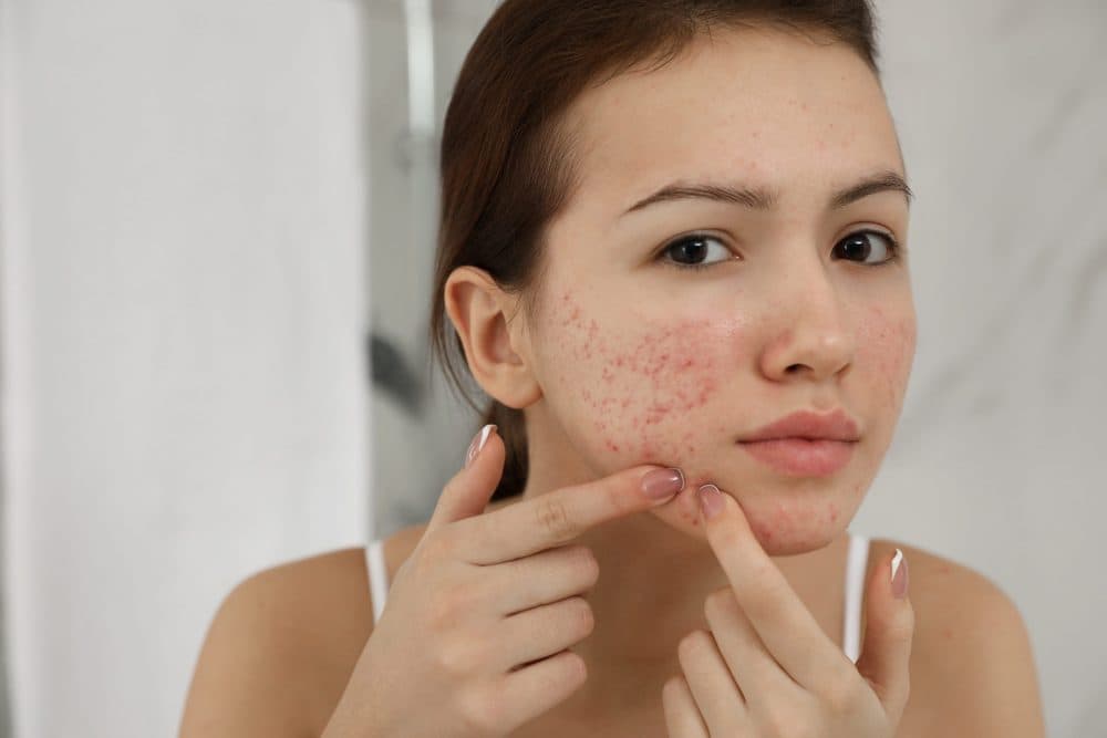 concern-acne-scars-2.jpg