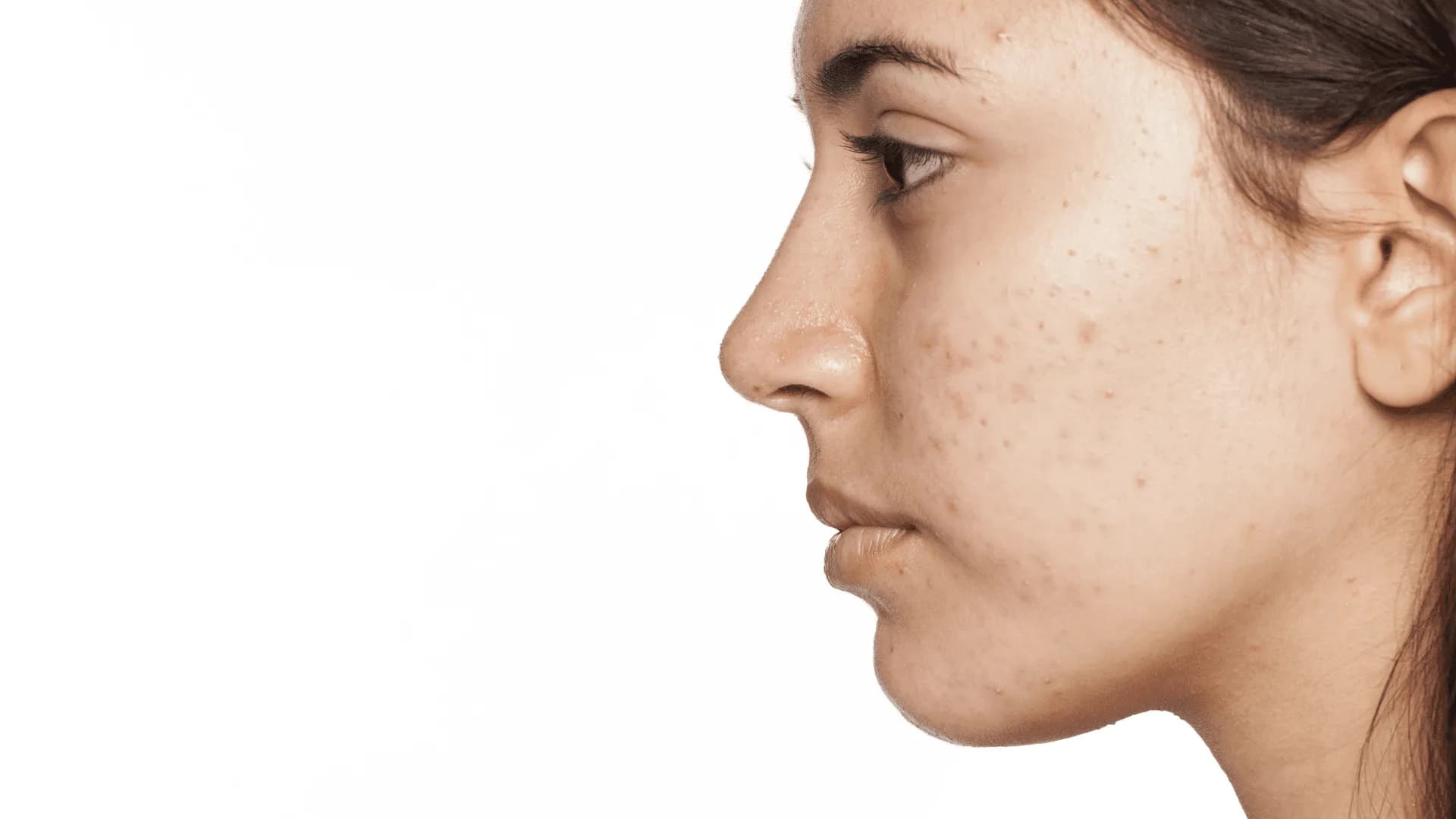 Acne Scars