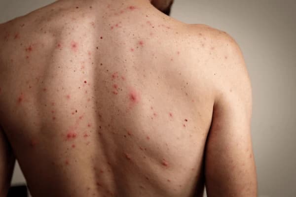 concern-back-acne-1.jpg