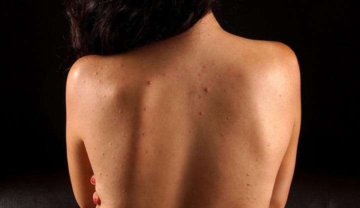 Back Acne