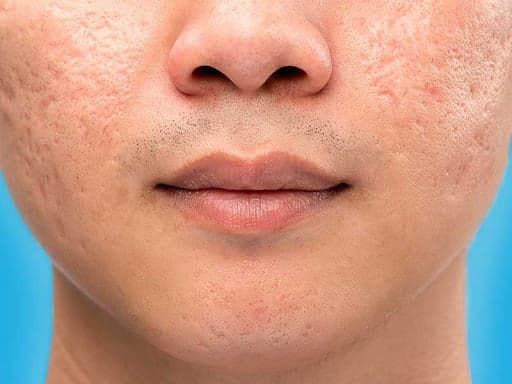 concern-open-pores-1.jpg
