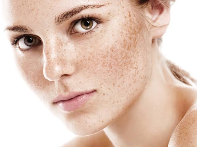 concern-pigmentation-2.jpg