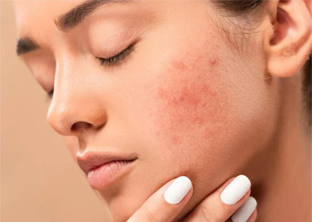 Dark spot treatment