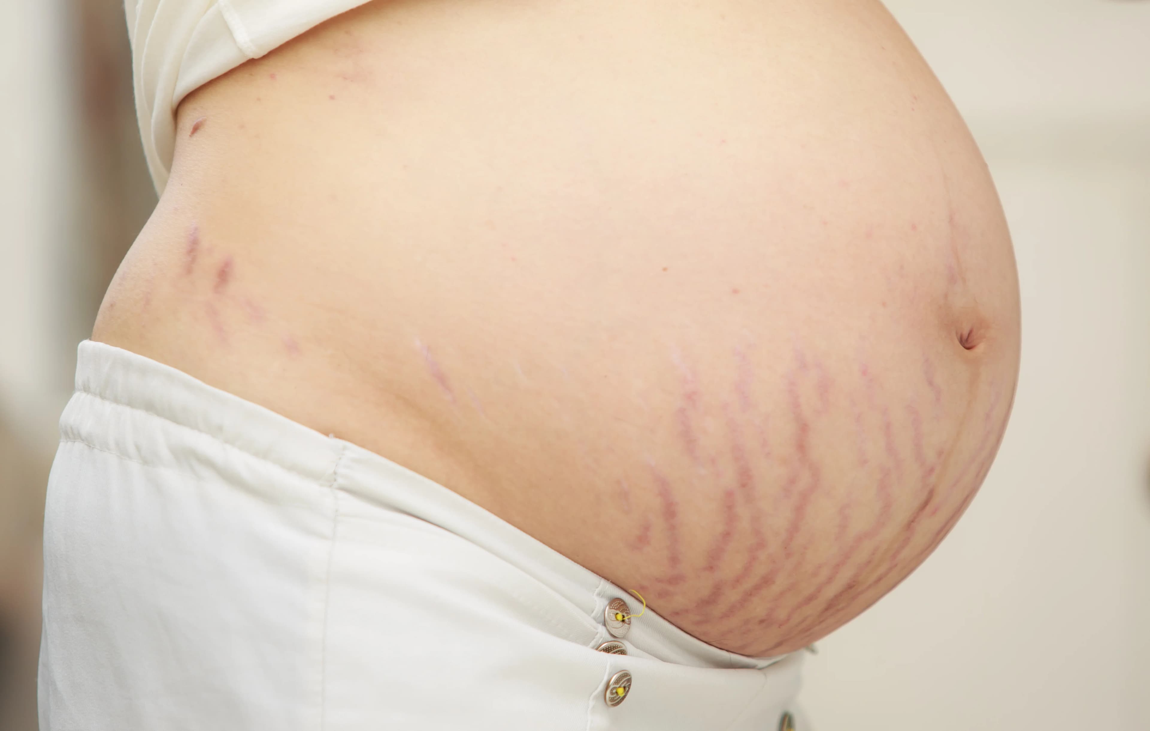 Stretch Marks