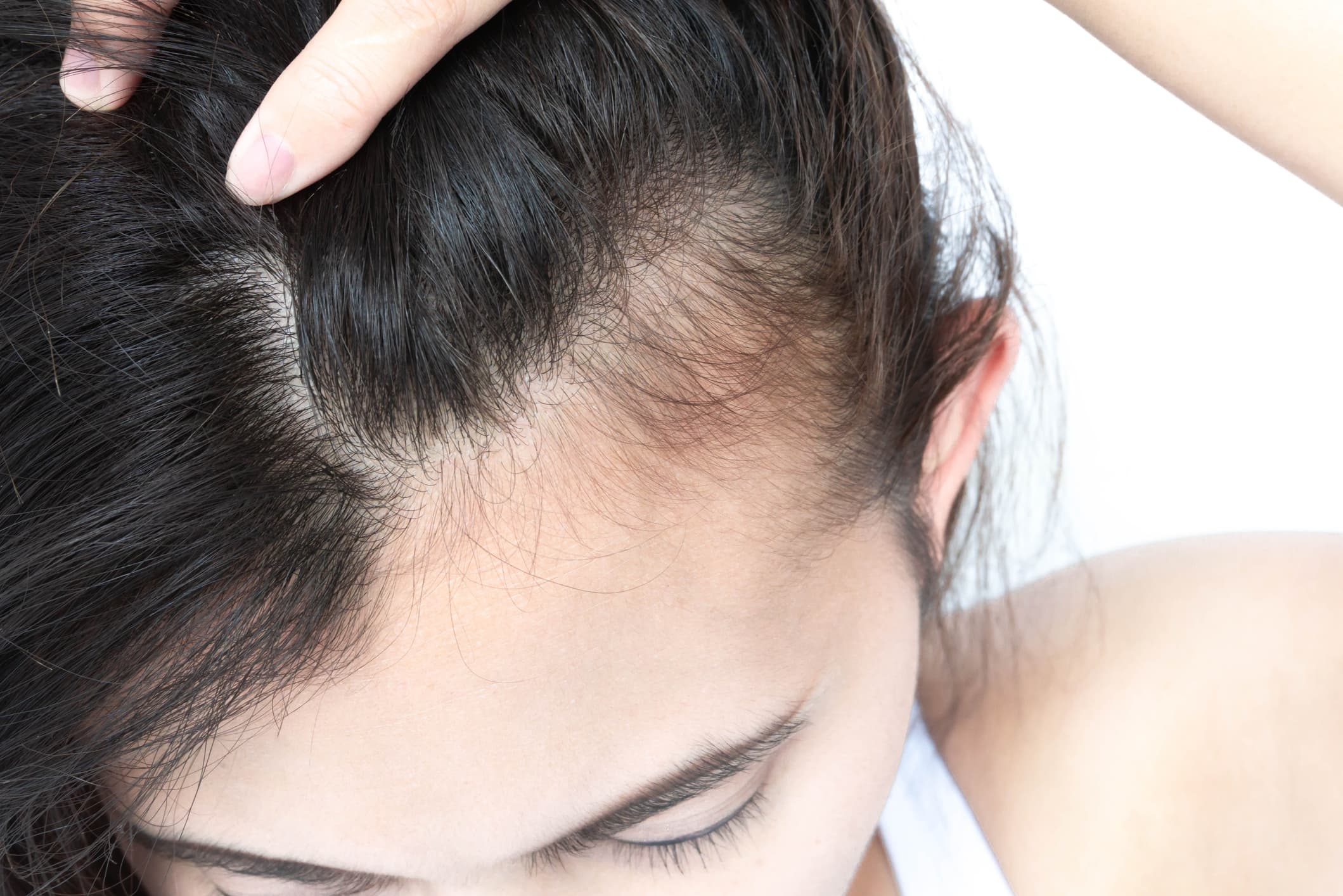 Hairfall IV Therapy