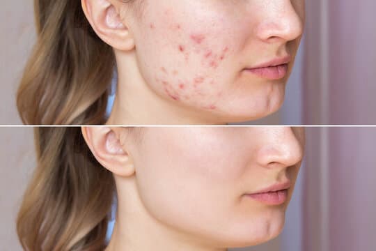 Acne Treatment