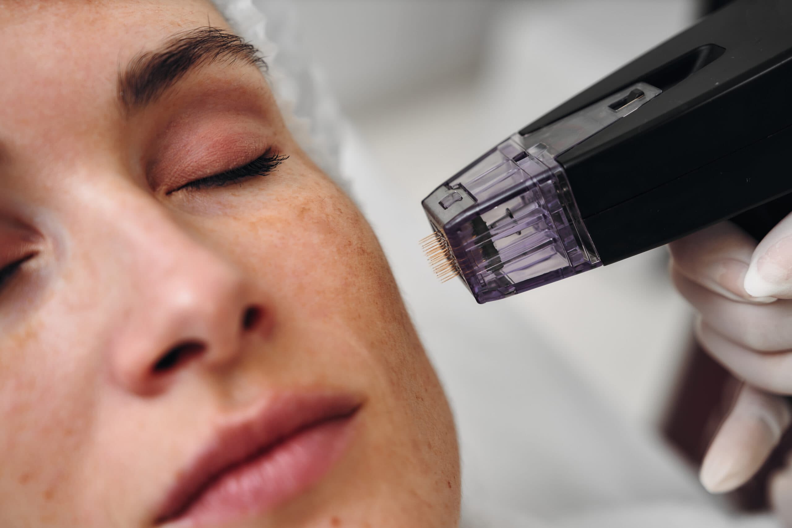 Acne Scars Treatment