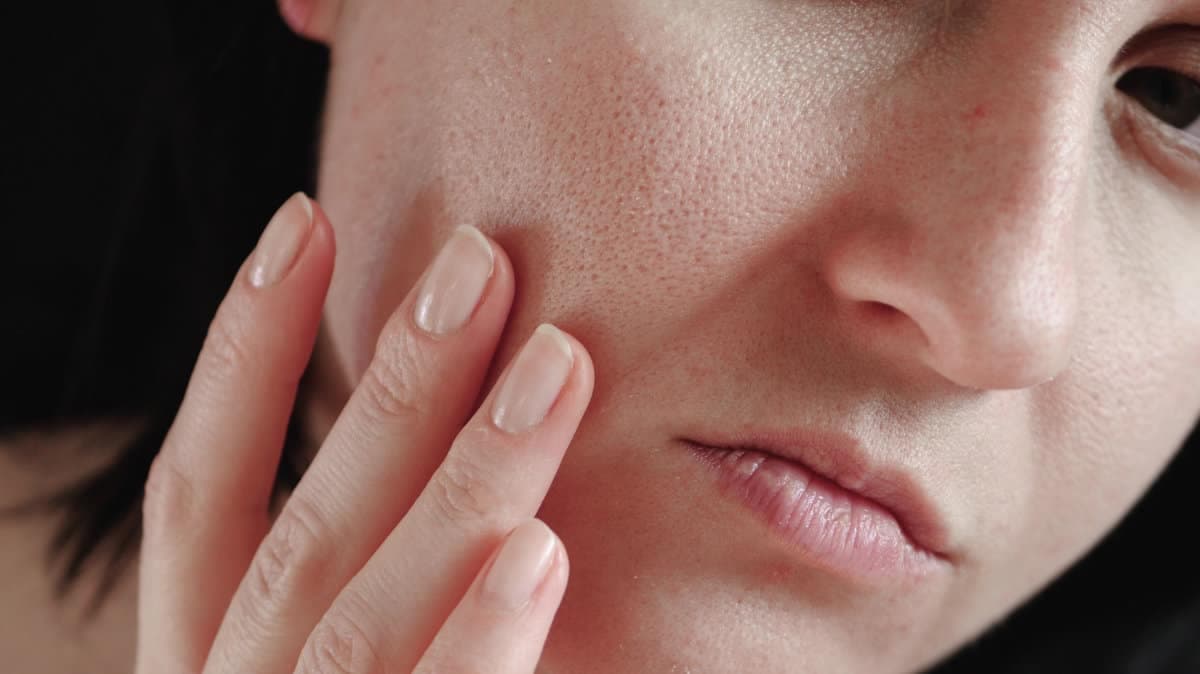 Baby Botox for Open Pores