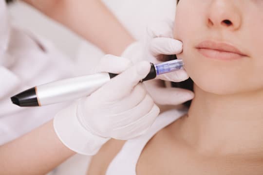 Dermapen4 for Acne and Pimples