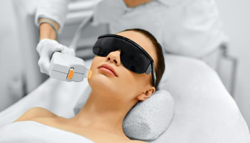 IPL for Acne and Pimples
