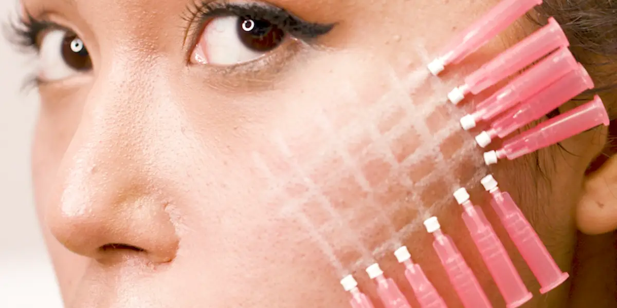 Mono Threads and Baby Botox for Acne Scars