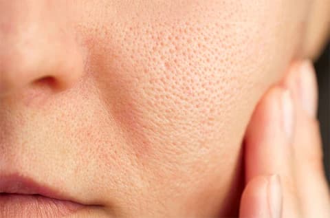 Open Pores Treatment