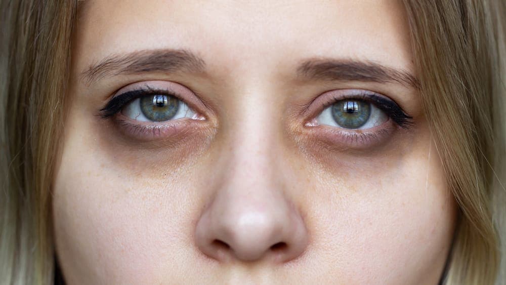 Salmon DNA for Undereye Rejuvenation