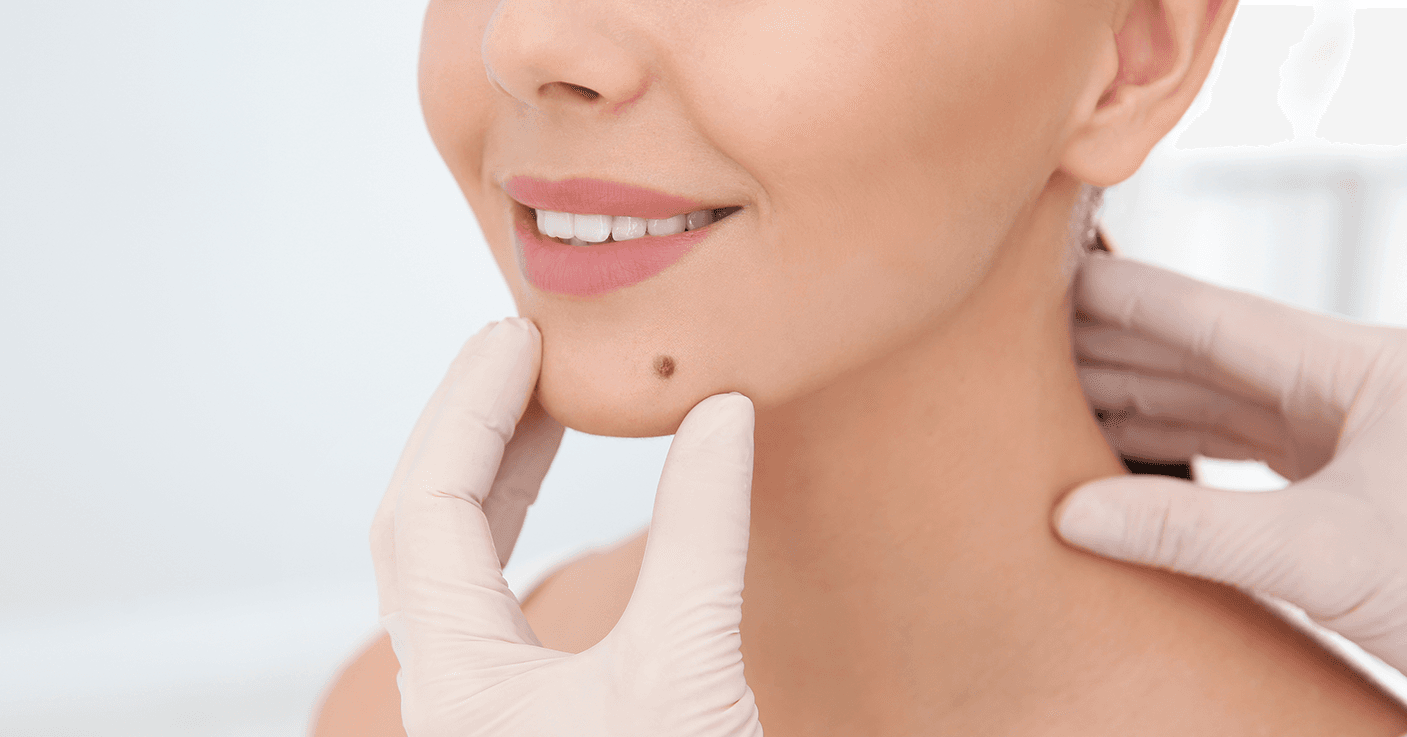 Tag / Wart / Mole Removal